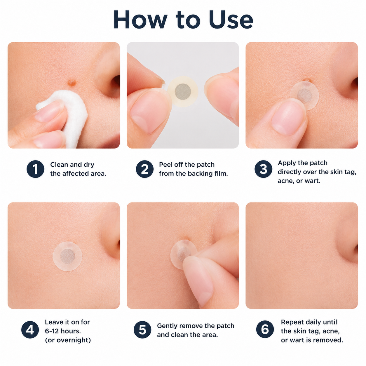 Alisanda®2-in-1 Microneedle & Hydrocolloid Patch🍀| Removes Raised Moles, Acne, Flat Warts & Skin Tags