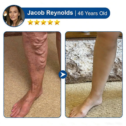 🇺🇸👨‍⚕️✅Alisanda® VeinTarget Microneedle Patch