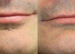 Alisanda®2-in-1 Microneedle & Hydrocolloid Patch🍀| Removes Raised Moles, Acne, Flat Warts & Skin Tags