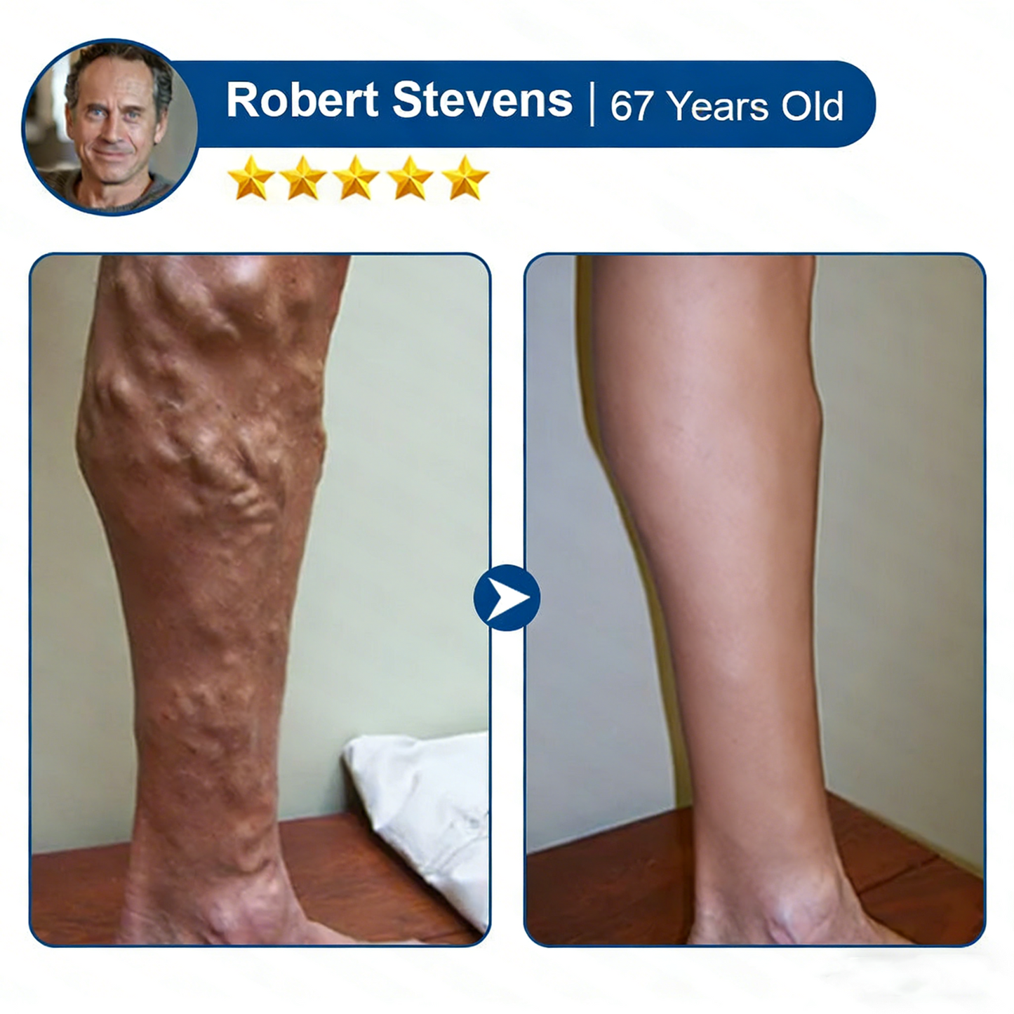🇺🇸👨‍⚕️✅Alisanda® VeinTarget Microneedle Patch